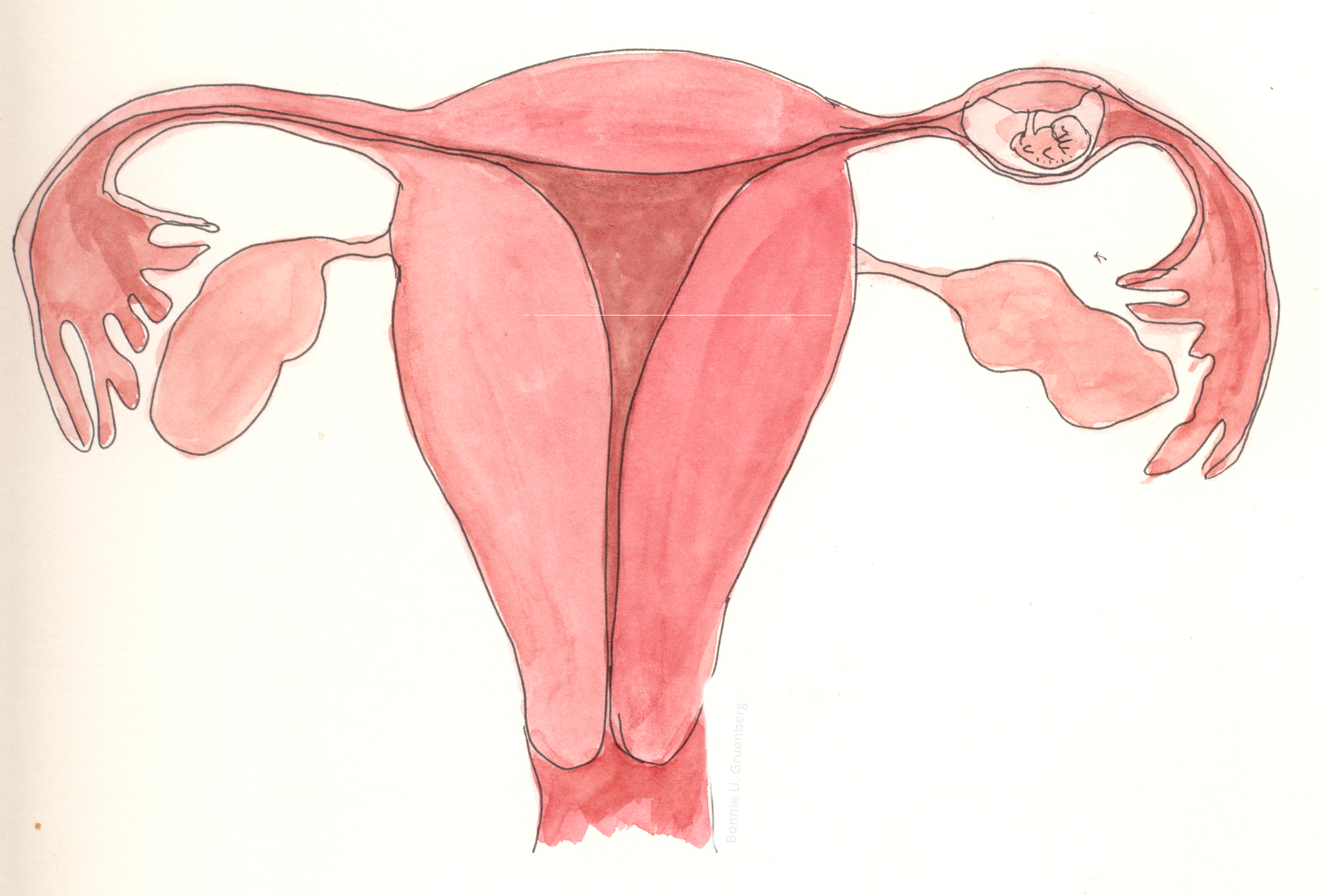 Ectopic_pregnancy_diagram tube baby