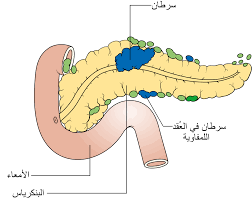 pancreas cancer diagram