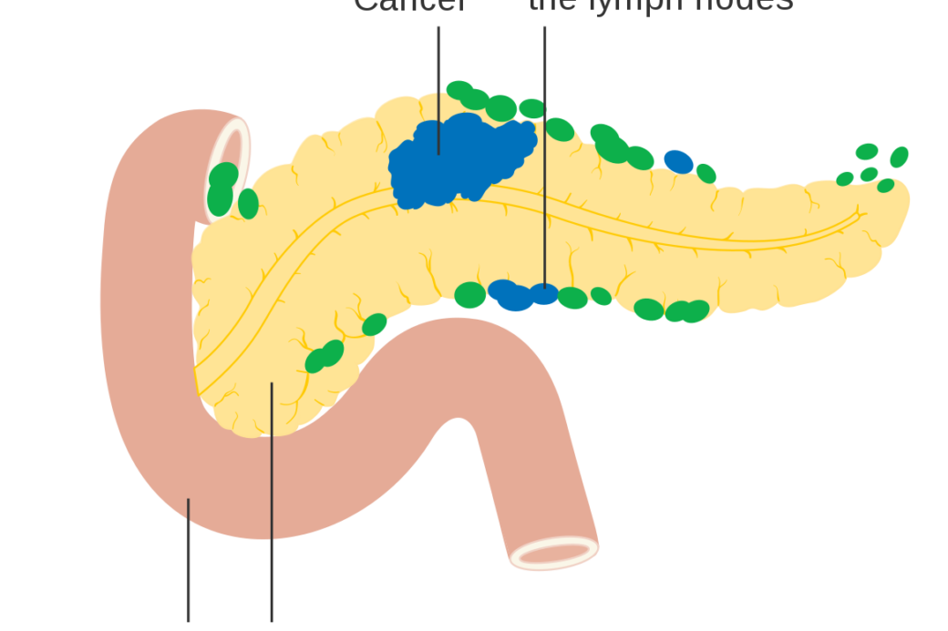 pancreatic-cancer-diagram
