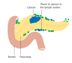 pancreatic-cancer-diagram